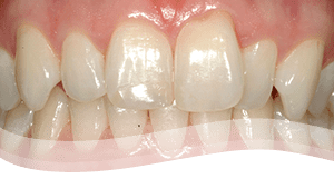 veneers procedure -before crooked teeth treatment