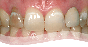 Tooth Veneers Process - severely discoloured tooth treatment