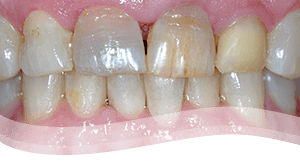 teeth veneers procedure