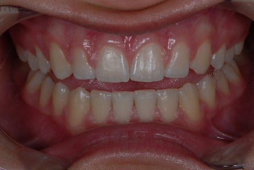 veneers procedure before image