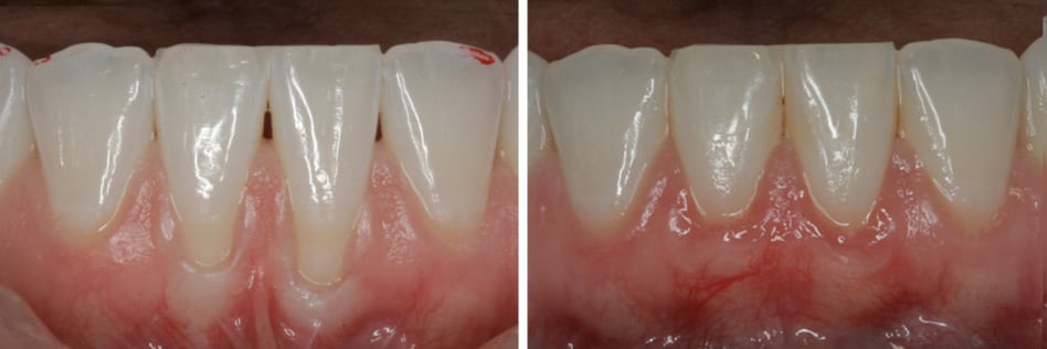 Regrow Receding Gums