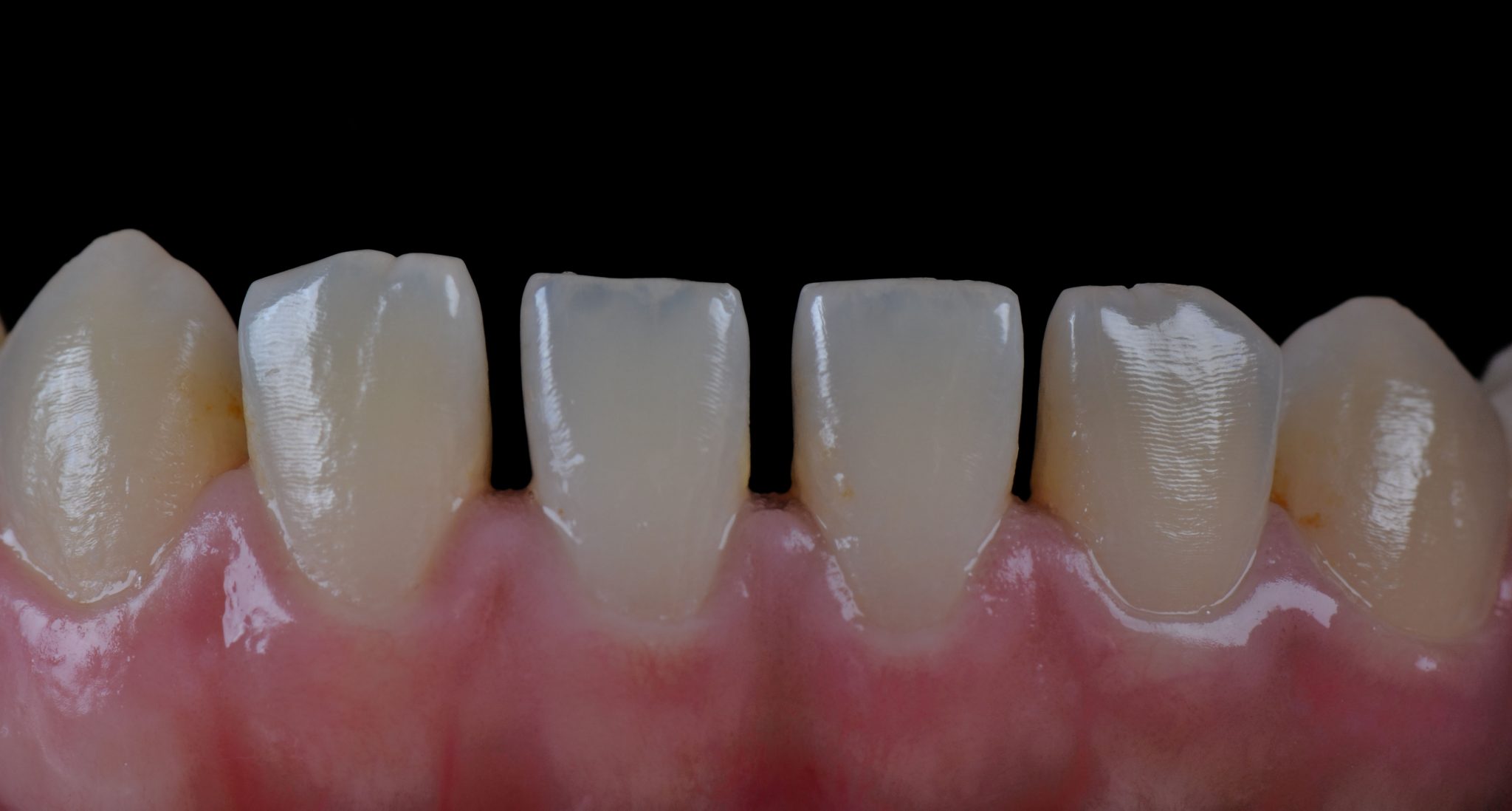 gaps inbetween teeth before photo
