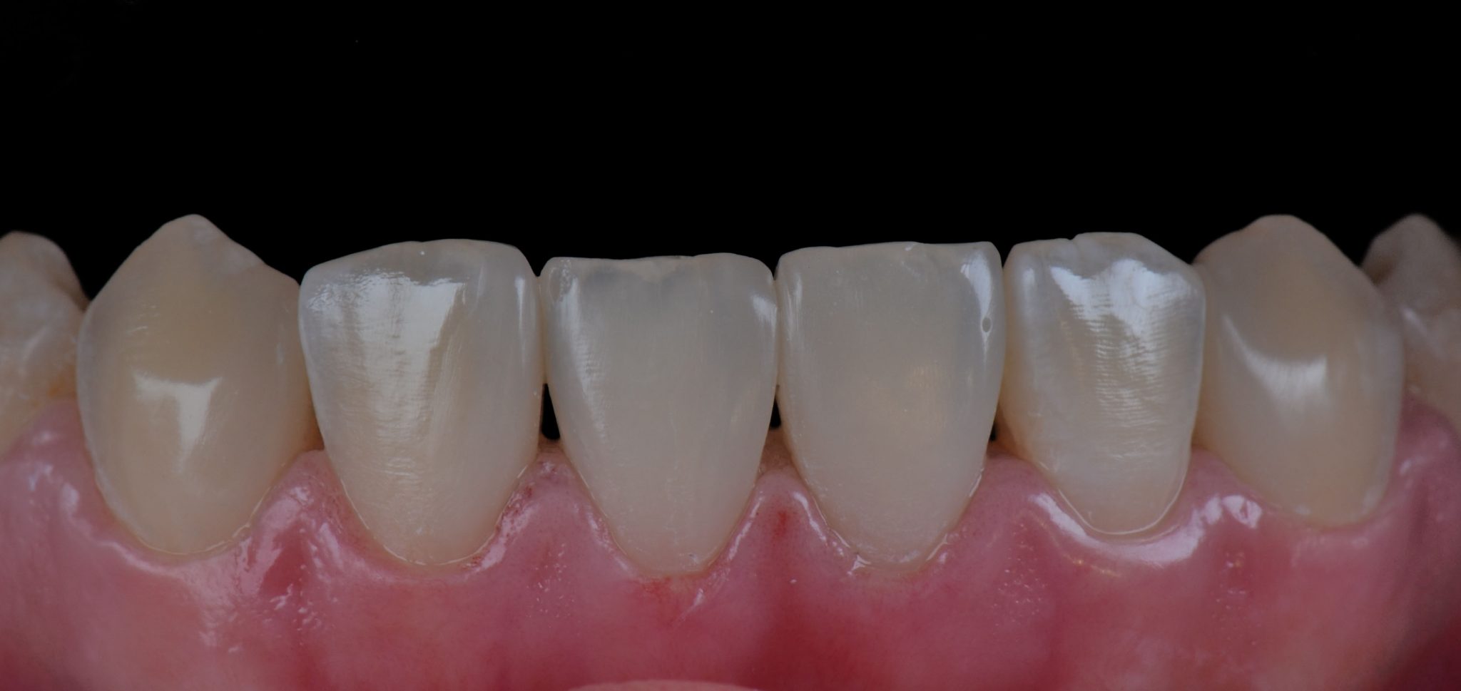 gaps inbetween teeth closed after photo