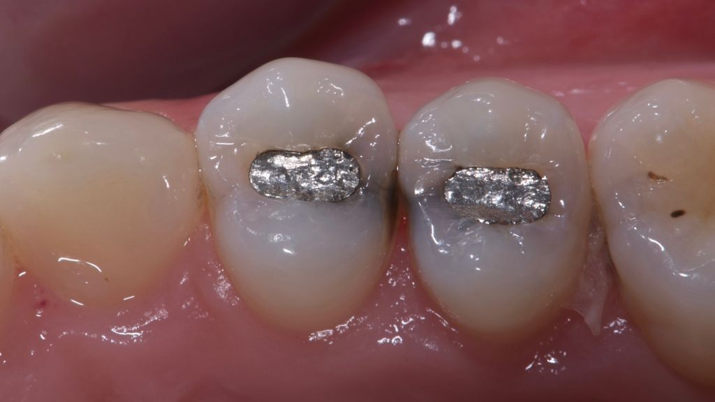 metal fillings before photo
