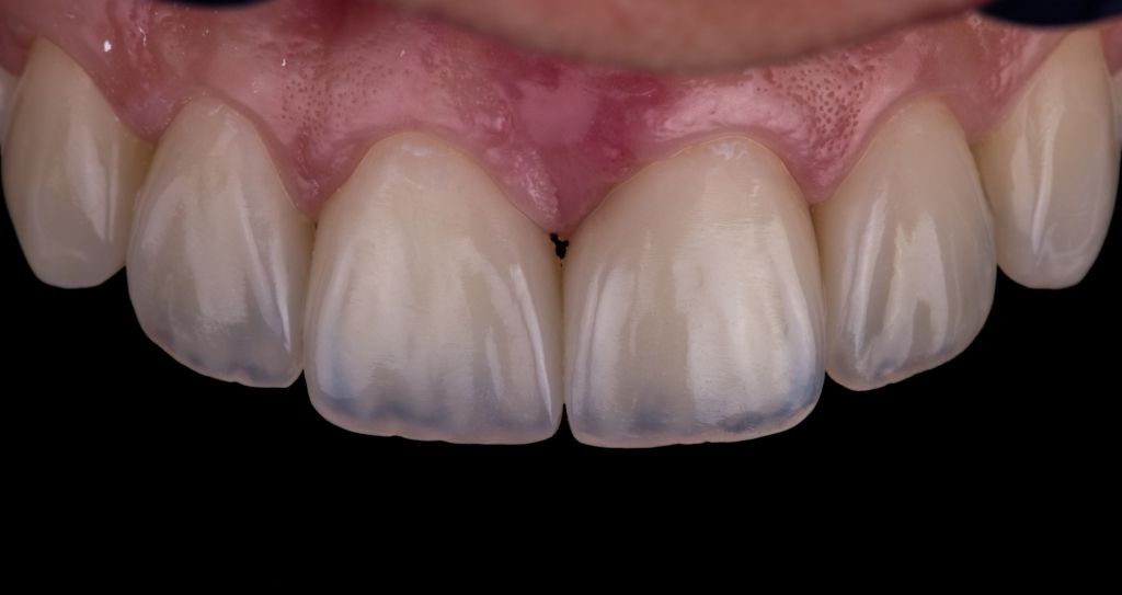 gapped front teeth after photo