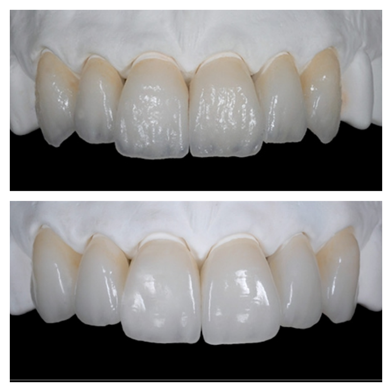 Veneers in Lancashire - Before After Pictures