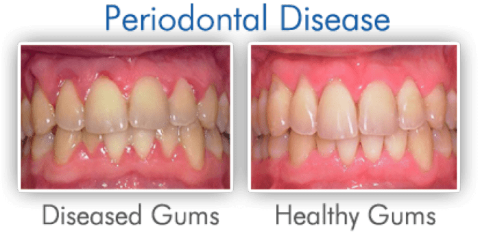 Gum Disease Periodontitis Lane Ends Dental Practice Preston