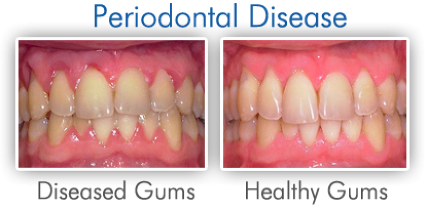 gum disease - bleeding gums before and after images