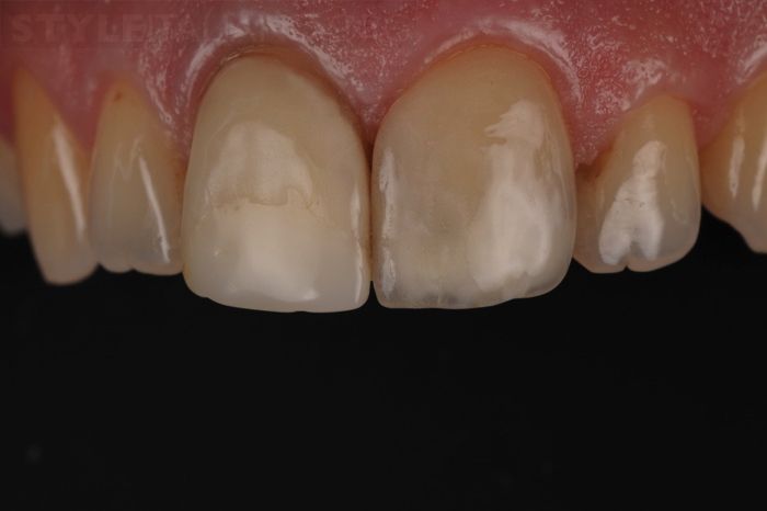 Porcelain Veneers in Lancashire - before treatment