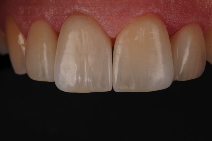 Veneers Lancashire - after treatment