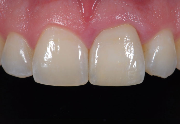 Cosmetic Dentistry Dental Crowns