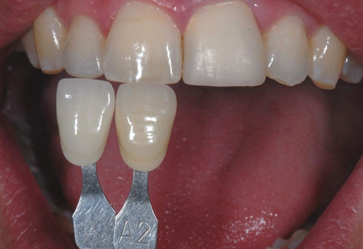 Dental Crowns Preston - Lane Ends Dental Practice