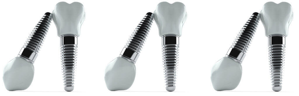 Dental Implants frequently Asked questions