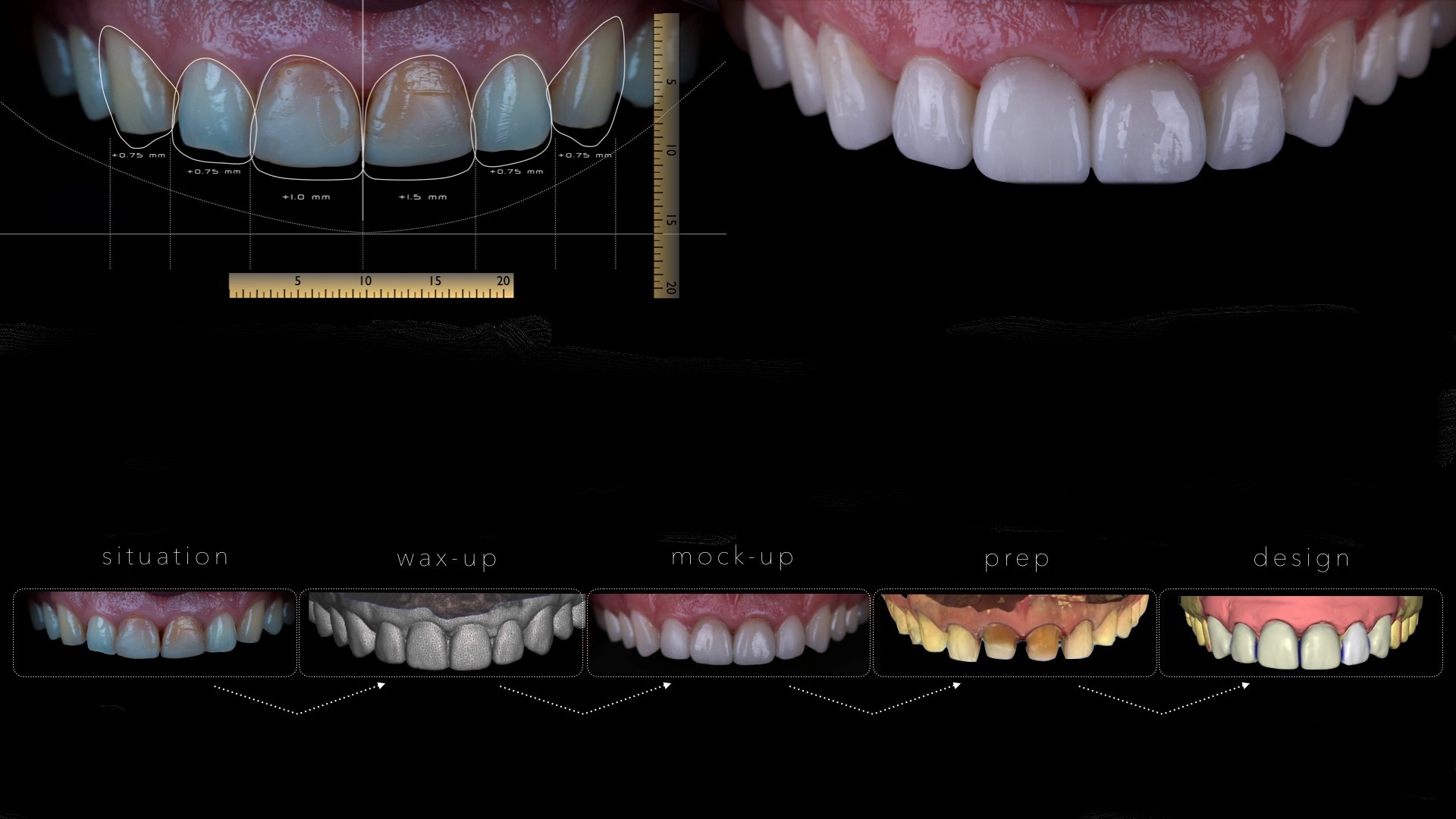 Cosmetic Porcelain Veneers | Dental Veneers | Teeth Veneers UK