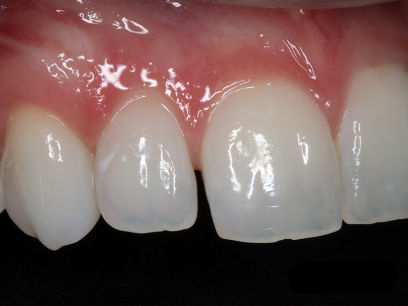 front tooth bonding before image