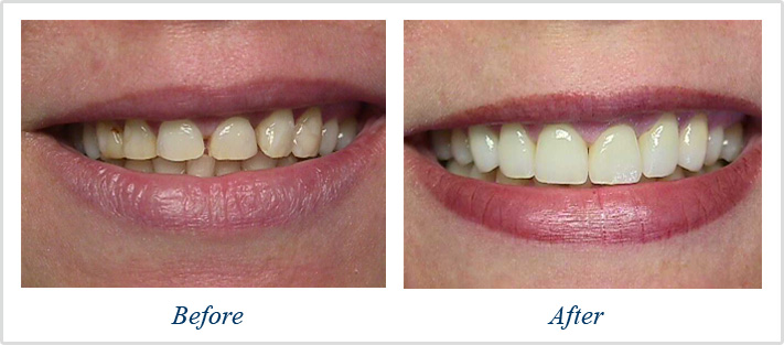 Best Veneers Dentist Smile Gallery