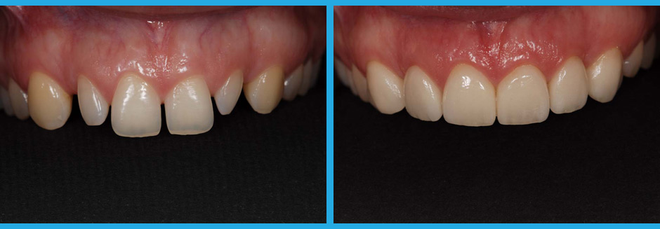 Tooth Veneers Before and After images