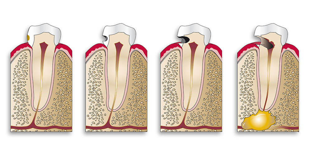 Root canal Specialist in Lancashire